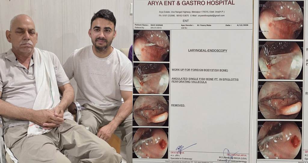 Doctors Save Life with Endoscopy After Fish Bone Gets Stuck in Throat